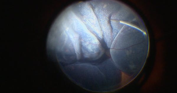Hemorrhagic Macular Degeneration-Related Retinal Detachment thumbnail