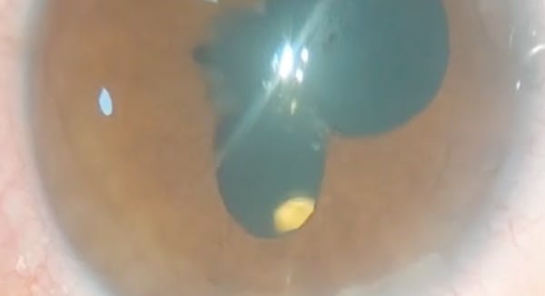 Managing Endogenous Endophthalmitis thumbnail