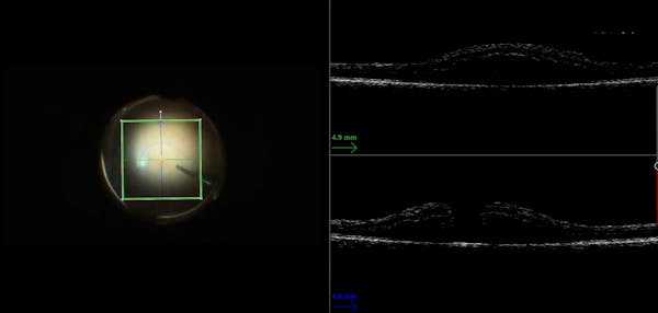 Amniotic Membrane for Refractory Macular Hole thumbnail