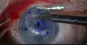 Intraoperative OCT-Assisted DSAEK Surgery