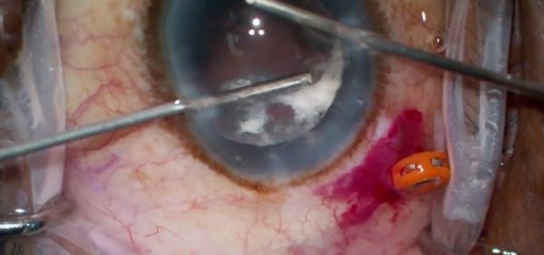 Management of Subluxated Traumatic Cataract With Vitreous Prolapse and Glaucoma thumbnail