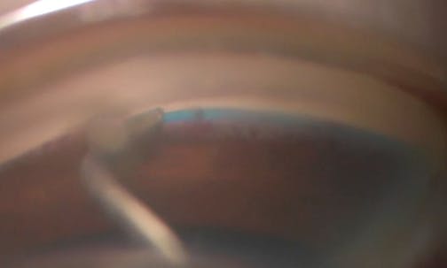 Combination Cataract Surgery and Omni Surgical System