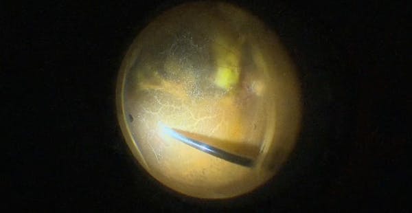 Large Neovascular Membrane thumbnail
