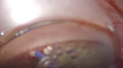 AlloFlo Triple Implant Placement