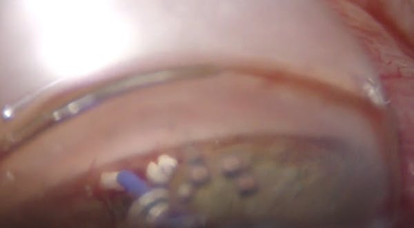 AlloFlo Triple Implant Placement thumbnail