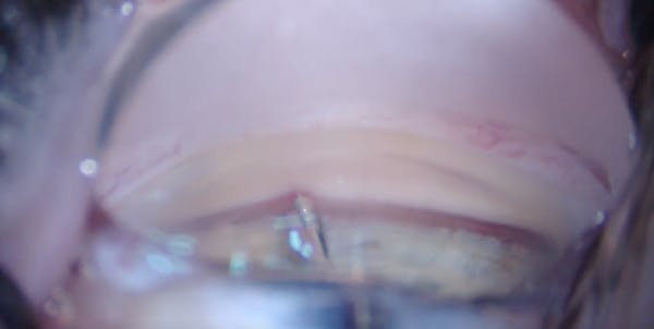 iDose With Stabilization Instrument thumbnail