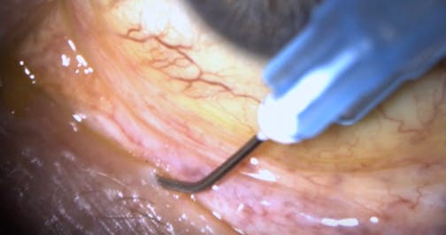 Lacrifill Insertion Pearls