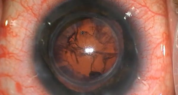 Removal of Epikeratophakia Graft With PEIOL and LAL Implantation thumbnail