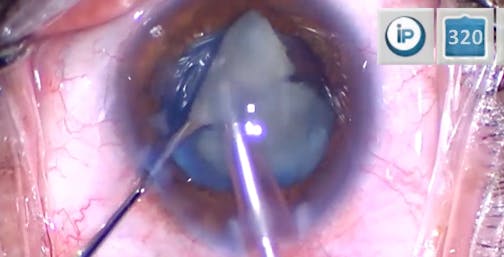 White Cataract, Multifocal Expectations: Why Not?