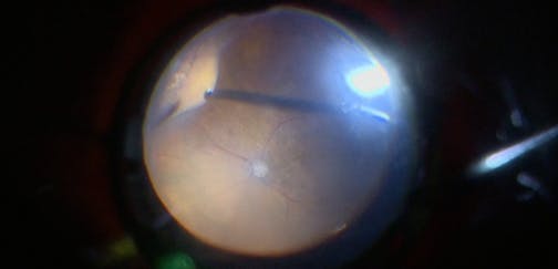 Long-Standing Vitreous Hemorrhage