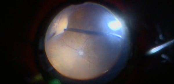 Long-Standing Vitreous Hemorrhage thumbnail