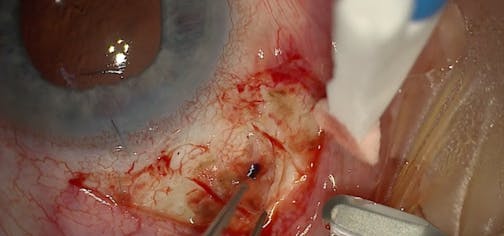 Scleral-Fixated Iluvien for Secondary Macular Edema