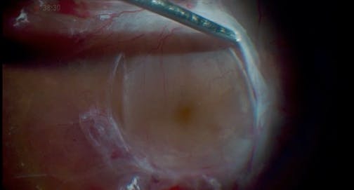 Refining Minimally Invasive Vitrectomy for PDR With Macular-Threatening Fibrous Tissue and TRD
