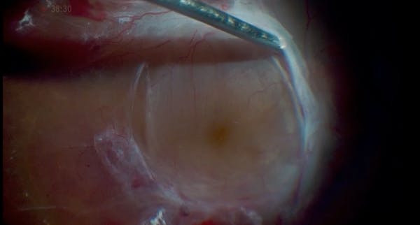 Refining Minimally Invasive Vitrectomy for PDR With Macular-Threatening Fibrous Tissue and TRD thumbnail