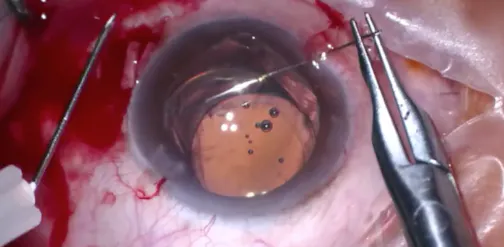 IOL Repositioning With Scleral Fixation