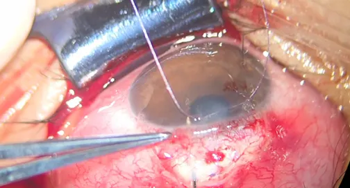 PreserFlo for Bilateral Juvenile Glaucoma With Hyperfiltrating Implant Replacement