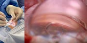 Angle of Approach With the VIA360 Surgical System