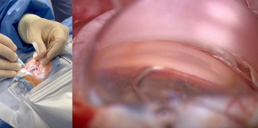 Angle of Approach With the VIA360 Surgical System