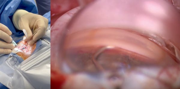 Angle of Approach With the VIA360 Surgical System thumbnail