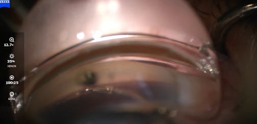 Hydrus Microstent Implantation: Teaching Video