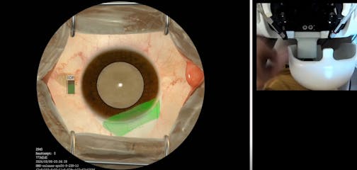 MSICS Sclero-Corneal Tunnel Construction