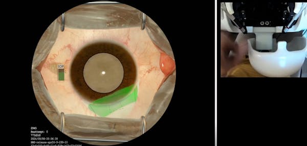 MSICS Sclero-Corneal Tunnel Construction thumbnail