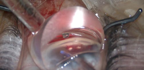 AlloFlo Triple Implant Placement (2-1)