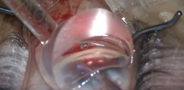 AlloFlo Triple Implant Placement thumbnail