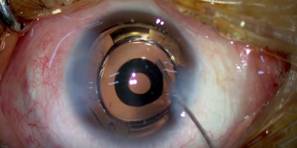 Artificial Capsular Bag thumbnail