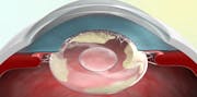 Novel Intraocular Open-Capsule Device for Preventing PCO