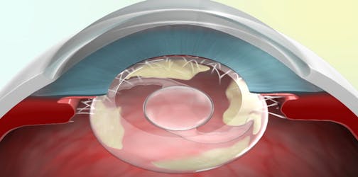 Novel Intraocular Open-Capsule Device for Preventing PCO