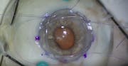 New Keratoprosthesis