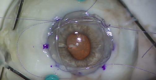 New Keratoprosthesis