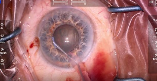 Sleeve Hydrodissection: Blocking Iris Prolapse in IFIS