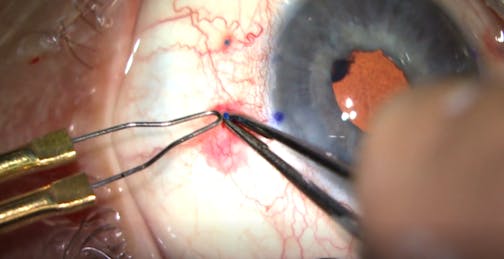 Refinement of the Flanged Scleral Fixation Technique