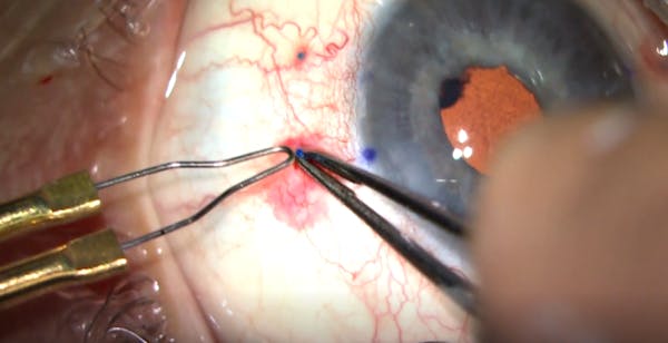 Refinement of the Flanged Scleral Fixation Technique thumbnail