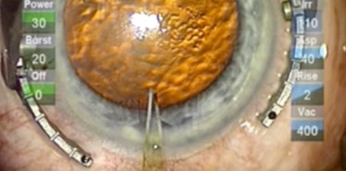 Incision Construction Using a Diamond Trapezoidal Blade
