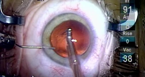 A Simple Extra Step to Prevent Retained Lens Material