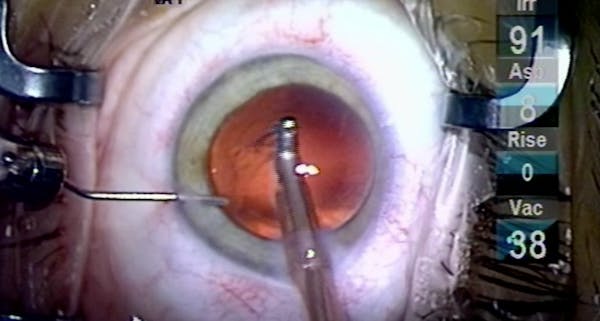 A Simple Extra Step to Prevent Retained Lens Material thumbnail