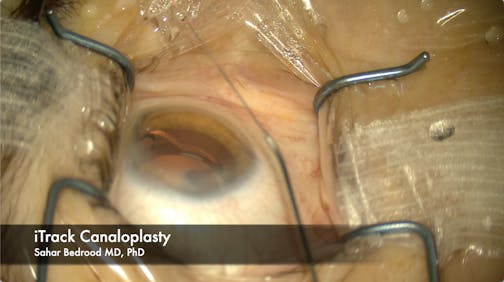 Canaloplasty with the iTrack Advance