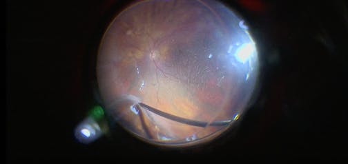Retinal Detachment in Patient With History of Stroke