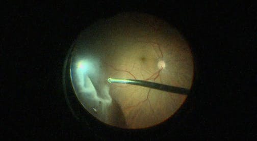 Phakic Retinal Detachment