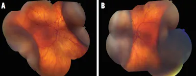 Watch for Choroidal Detachments in Cryptococcosis image