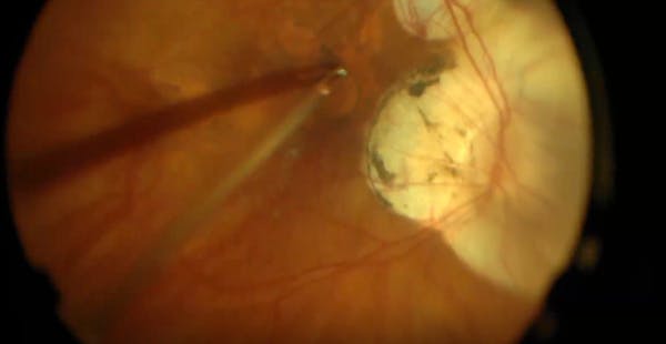 Inverted ILM Flap in a Pathological Myopic Eye With a Chronic Large Macular Hole thumbnail