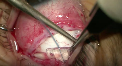 Glaucoma Implant in Pediatric Case With Aphakic Glaucoma After Cataract Surgery