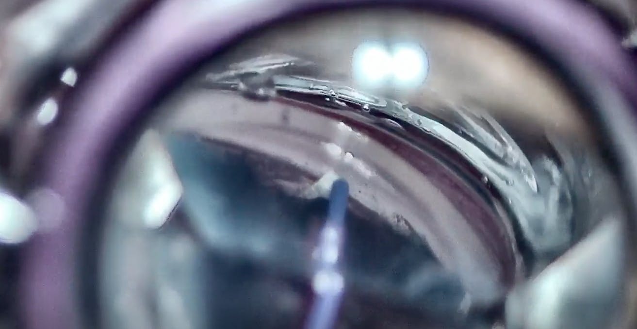 AlloFlo Supraciliary Procedure In Eye With Previous Surgery - Eyetube