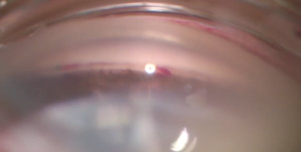 Interventional Glaucoma: iStent and iDose thumbnail