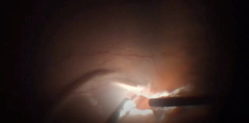 The 'Light Pipe Trick' to Safely Perform Fluid-Air Exchange