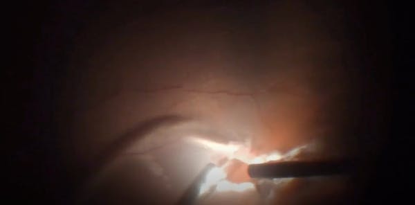 The 'Light Pipe Trick' to Safely Perform Fluid-Air Exchange thumbnail