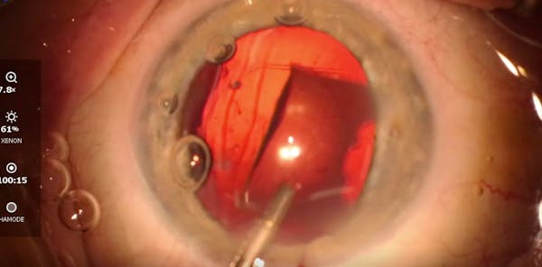 IOL Exchange, Post-YAG Laser Capsulotomy thumbnail